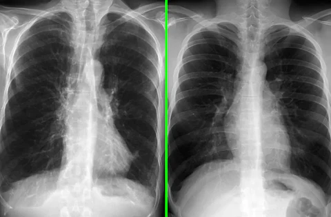 Seurico™ Lung Detox Handnebulizer