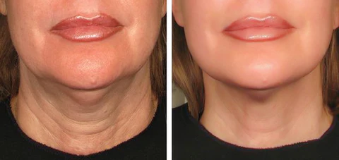 Fivfivgo™ LuxPro Bienengift-Serum