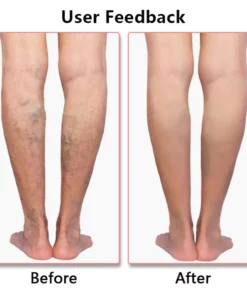 Fivfivgo™ Varizen Premium-Kompressionsstrümpfe