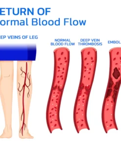 Alternative view of GFOUK™ Varicesness Treatment Patch