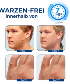 Alternative view of GFOUK™ WartsClean Creme zur Beseitigung von Warzen