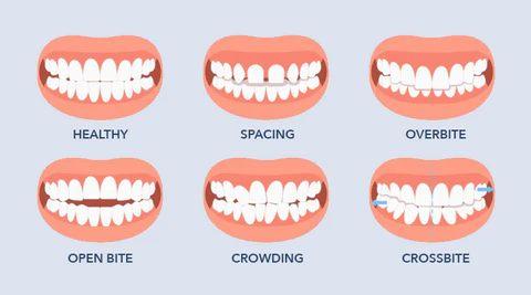 LIMETOW™ Dental Orthodontic Braces 