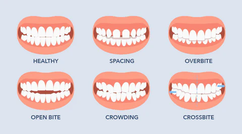 LIMETOW ™ Dental Ortodontyske beugels