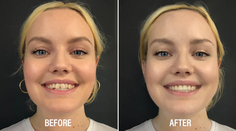 LIMETOW ™ Dental Ortodontyske beugels