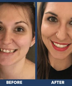 LIMETOW™ Dental Orthodontic Braces