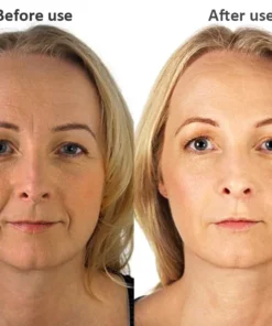 LIMETOW™ Soluble 24k Gold Protein Lifting Thread