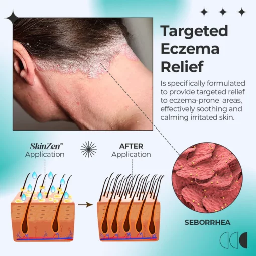 SkinZen™ Relief Eczema Roller Treatment - Image 4