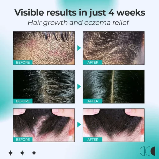 SkinZen™ Relief Eczema Roller Treatment - Image 6