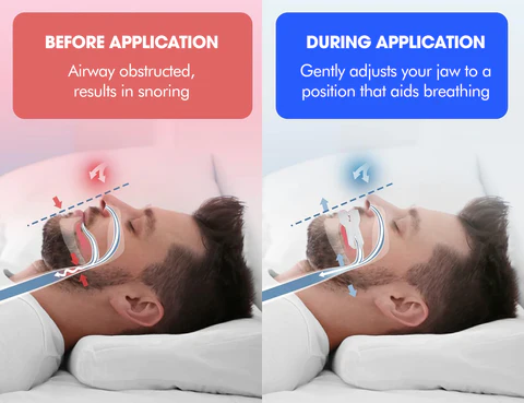 SleepZ™ Snore-free Mouth Piece