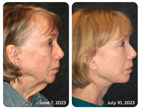 flysmus™ BeautyTENS VFace Facial Pules-toestel