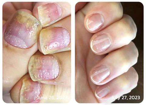flysmus™ OnycholysisHeal Nail Strengthening And Growth Conditioner