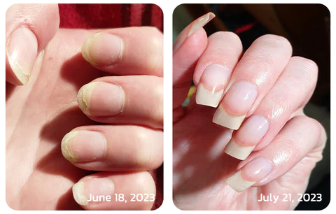 flysmus™ OnycholysisHeal Nail Strengthening And Growth Conditioner