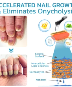 flysmus™ OnycholysisHeal Nail Strengthening And Growth Conditioner