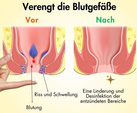 AEXZR™ Hämorrhoiden-Linderungscremewirksam