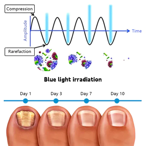 Biancat™ Nail Fungal Infection Repair Device