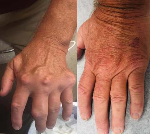 Ceoerty™ BoneNJoint Bee Venom Therapy -suihke