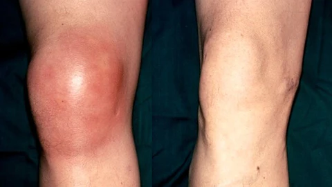 Ceoerty™ BoneNJoint Bee Venom Therapy -suihke