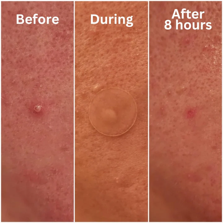 Fivfivgo™ Nighttime Acne Patch