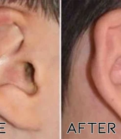 Fivfivgo™ DrWave Tinnitus NerveTreat Thermal Pen