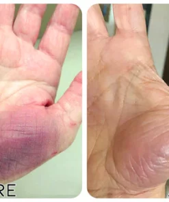 Fivfivgo™ EaseNerve Hände und Füße Pflaster