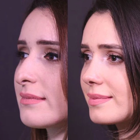 Fivfivgo™ Magisches Nasenformungsgerät