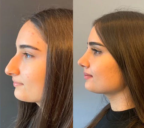 Fivfivgo™ Magisches Nasenformungsgerät