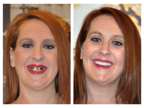 Fivfivgo™ Pflanzlicher aufhellender Reparaturschaum für den Mund