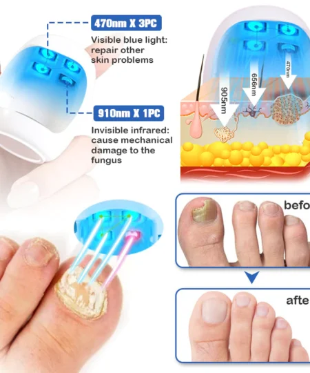 Furzero™ Nail Fungus Cleaning Laser Relief Device
