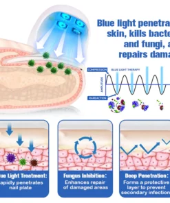 Furzero™ Nail Fungus Cleaning Laser Relief Device