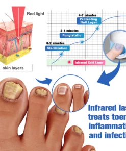 Furzero™ Nail Fungus Cleaning Laser Relief Device