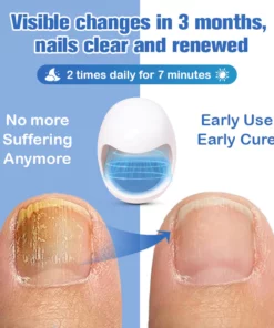 Furzero™ Nail Fungus Cleaning Laser Relief Device