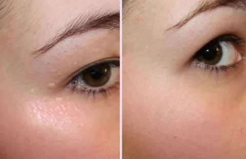 Furzero™ Tea Tree Terpineol Eye Mite Removal Wipes
