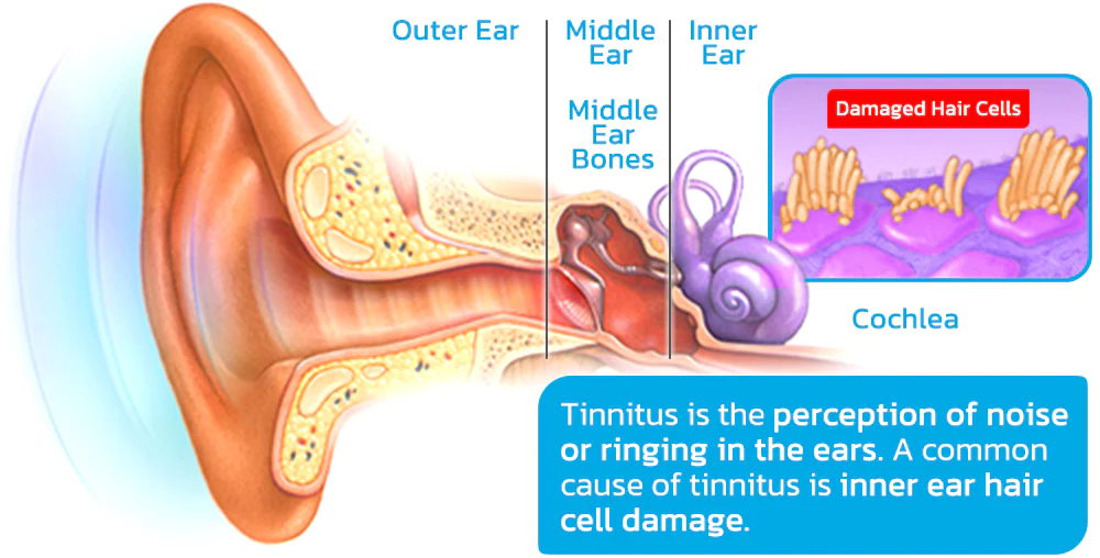 GFOUK™ DrWave Tinnitus NerveTreat Thermal Pen
