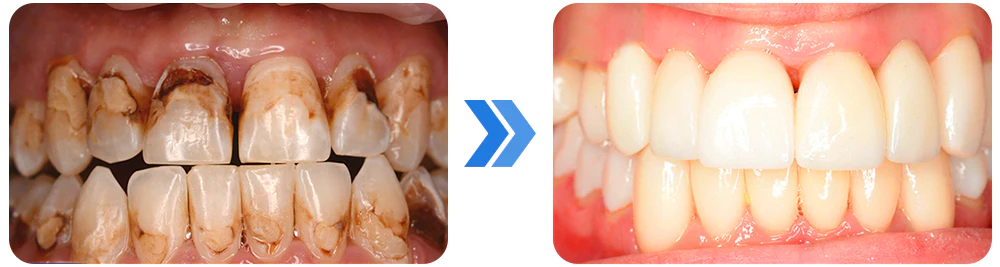GFOUK™ Gum Repair Strips