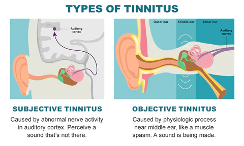 GFOUK™ ClearEar Tinnitus Relief Spray
