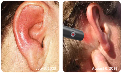 GFOUK™ DrWave Tinnitus NerveTreat Thermal Pen