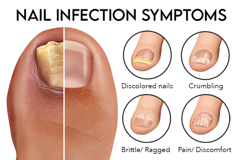 GFOUK™ FungiGuard Nail Treatment Cream
