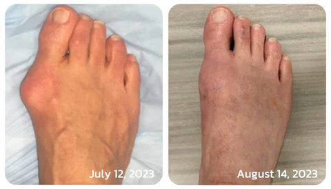 GFOUK™ HealthToe Joint Correcter Pression Patch