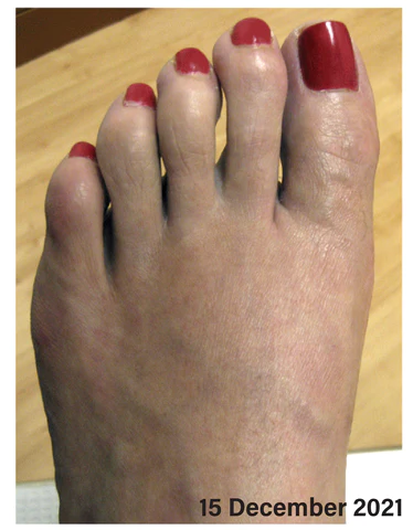 JointCare Anti Bunion Treatment Oil