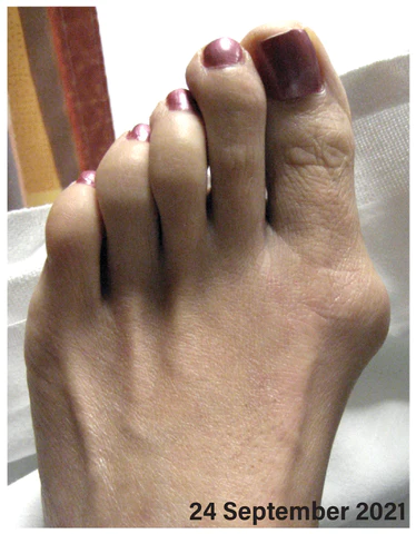 JointCare Anti Bunion Treatment Oil