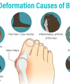 JointCare Anti Bunion Treatment Oil