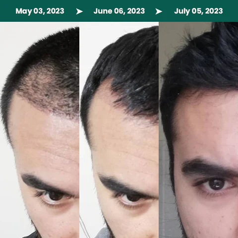 LIMETOW™ Hair Growth Spray

