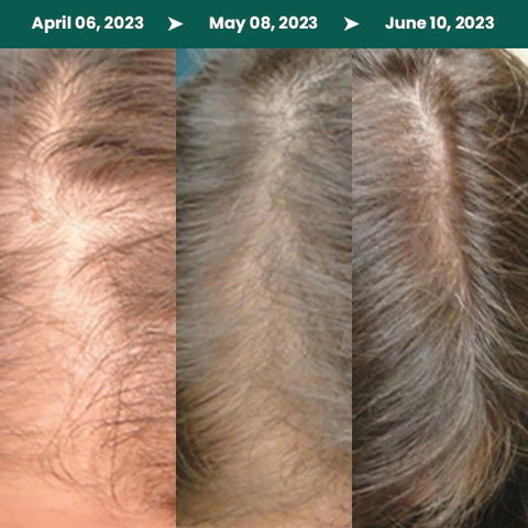 LIMETOW™ Natural Vegan Hair Growth Oil 