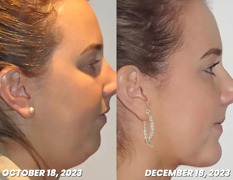 Liascy™ Lymphatech Gemslim CurvedCross -korvakorut