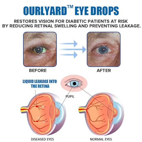 Ourlyard™ Eye drops for treating vision issues