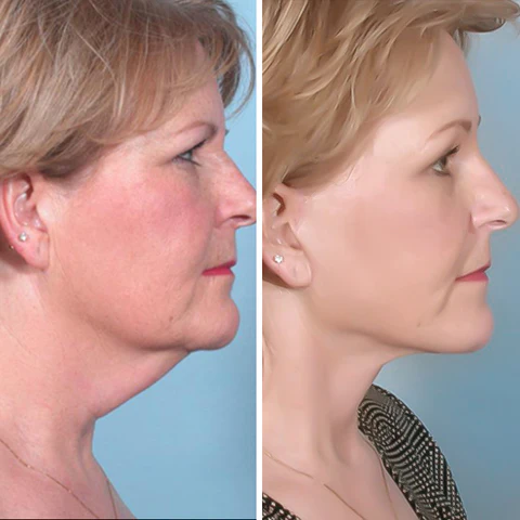 Nurbini™ UltraRenew ultrasound facelift device