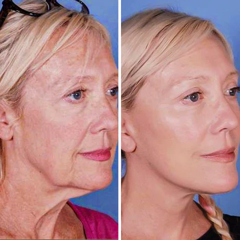 Oveallgo™ UltraRenew Ultrasonic Facelift Device
