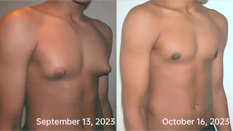 Sugoola™ Far-Infrared Tourmaline Therapy Gynecomastia Mens Undershirt