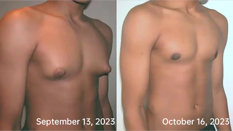 Sugoola™ Far-Infrared Tourmaline Therapy Gynecomastia Miesten aluspaita