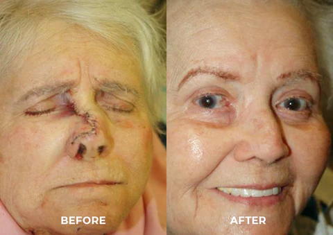 UNPREE™ Silicone Scar Removal Gel